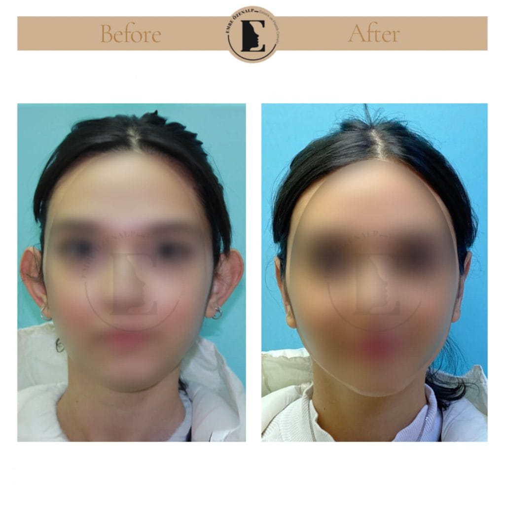 Otoplasty (prominent ear surgery) before after in Turkey results with experienced doctor Emre Özenalp. The patient has been done otoplasty surgery.