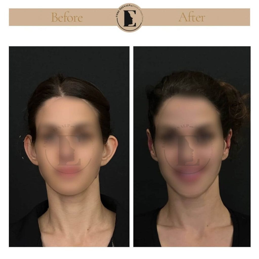 Otoplasty (prominent ear surgery) before after in Turkey results with experienced doctor Emre Özenalp. The patient has been done otoplasty surgery.
