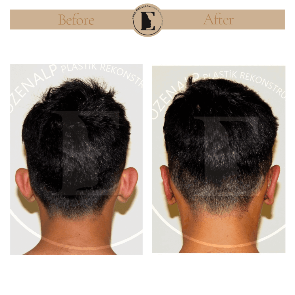 Otoplasty (prominent ear surgery) before after in Turkey results with experienced doctor Emre Özenalp. The patient has been done otoplasty surgery.