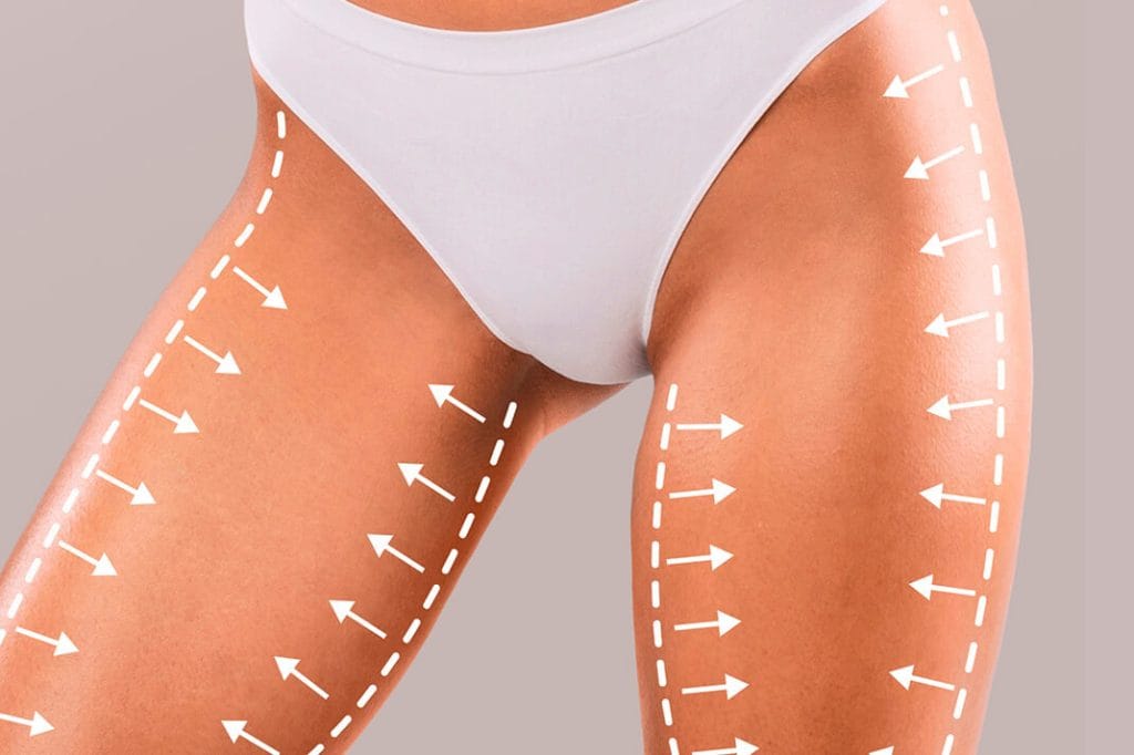 Thigh Lift in Turkey