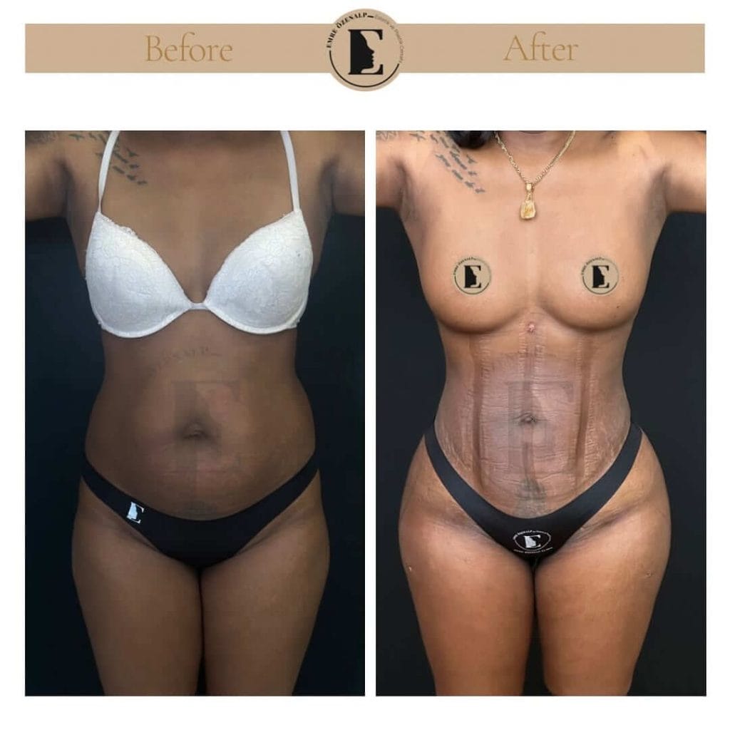 Liposuction before after in Turkey results with experienced doctor Emre Özenalp. The patient has been remove excess fat from abdomen area.