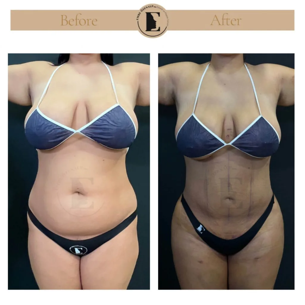 Liposuction before after in Turkey results with experienced doctor Emre Özenalp. The patient has been remove excess fat from abdomen area.