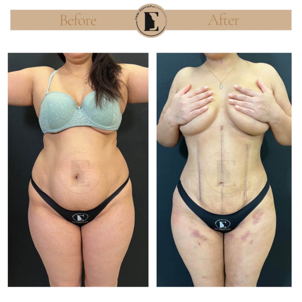 Liposuction before after in Turkey results with experienced doctor Emre Özenalp. The patient has been remove excess fat from abdomen area.