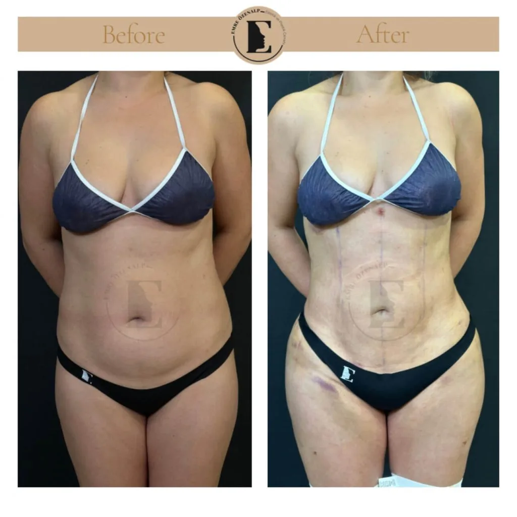 Liposuction before after in Turkey results with experienced doctor Emre Özenalp. The patient has been remove excess fat from abdomen area.