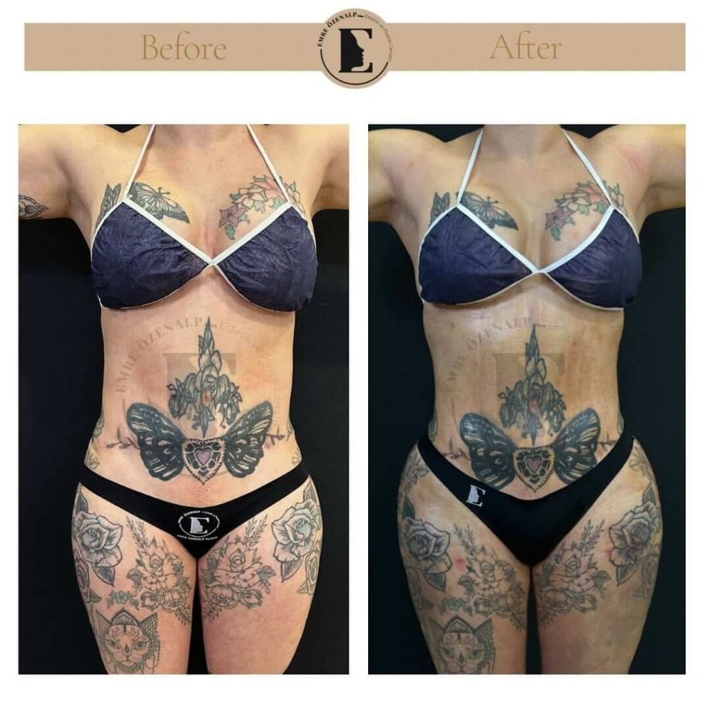 Liposuction before after in Turkey results with experienced doctor Emre Özenalp. The patient has been remove excess fat from abdomen area.