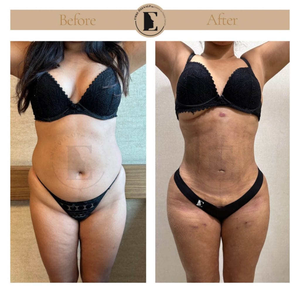 Liposuction before after in Turkey results with experienced doctor Emre Özenalp. The patient has been remove excess fat from abdomen area.