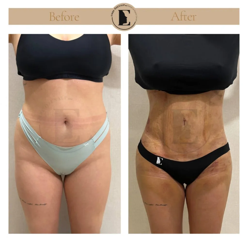 Liposuction before after in Turkey results with experienced doctor Emre Özenalp. The patient has been remove excess fat from abdomen, flanks area.