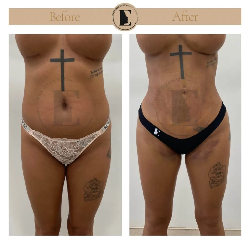 Liposuction before after in Turkey results with experienced doctor Emre Özenalp. The patient has been remove excess fat from abdomen, flanks area.