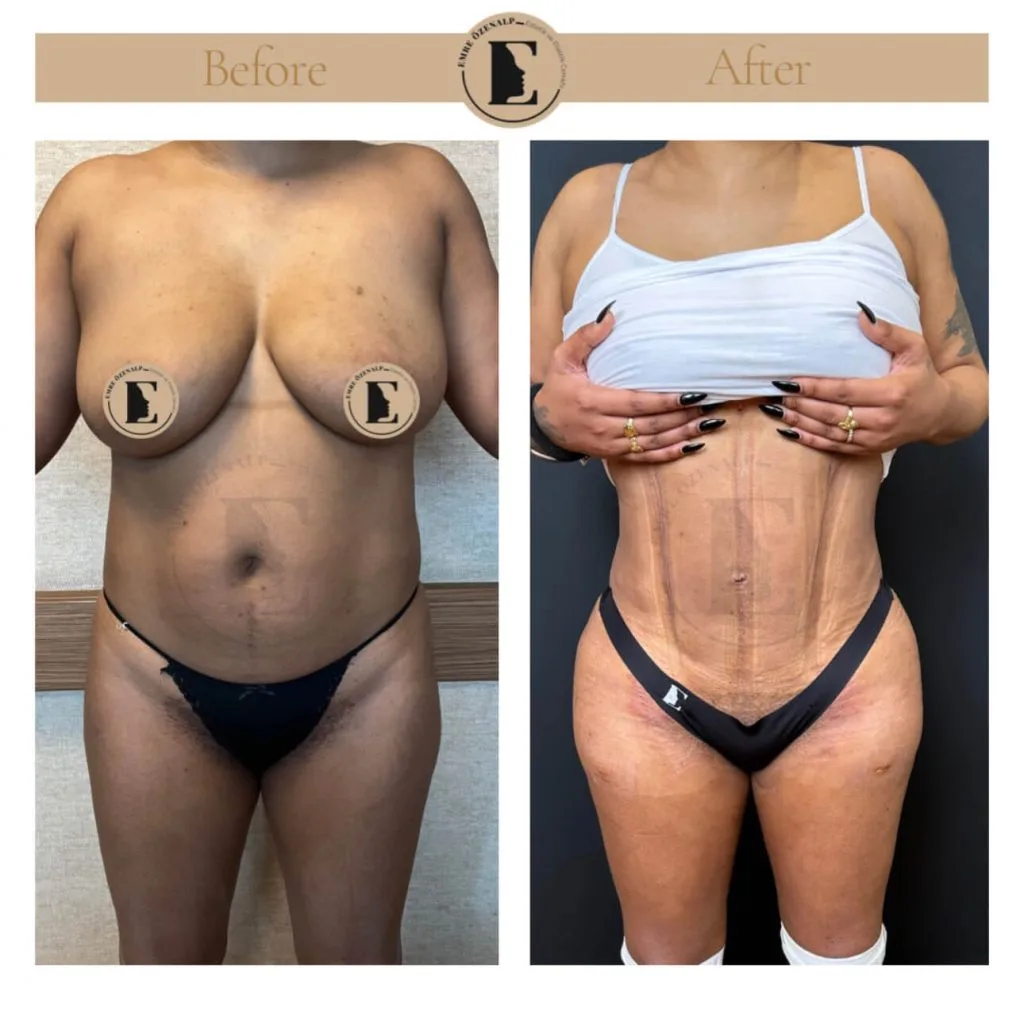 Liposuction before after in Turkey results with experienced doctor Emre Özenalp. The patient has been remove excess fat from abdomen, flanks area.