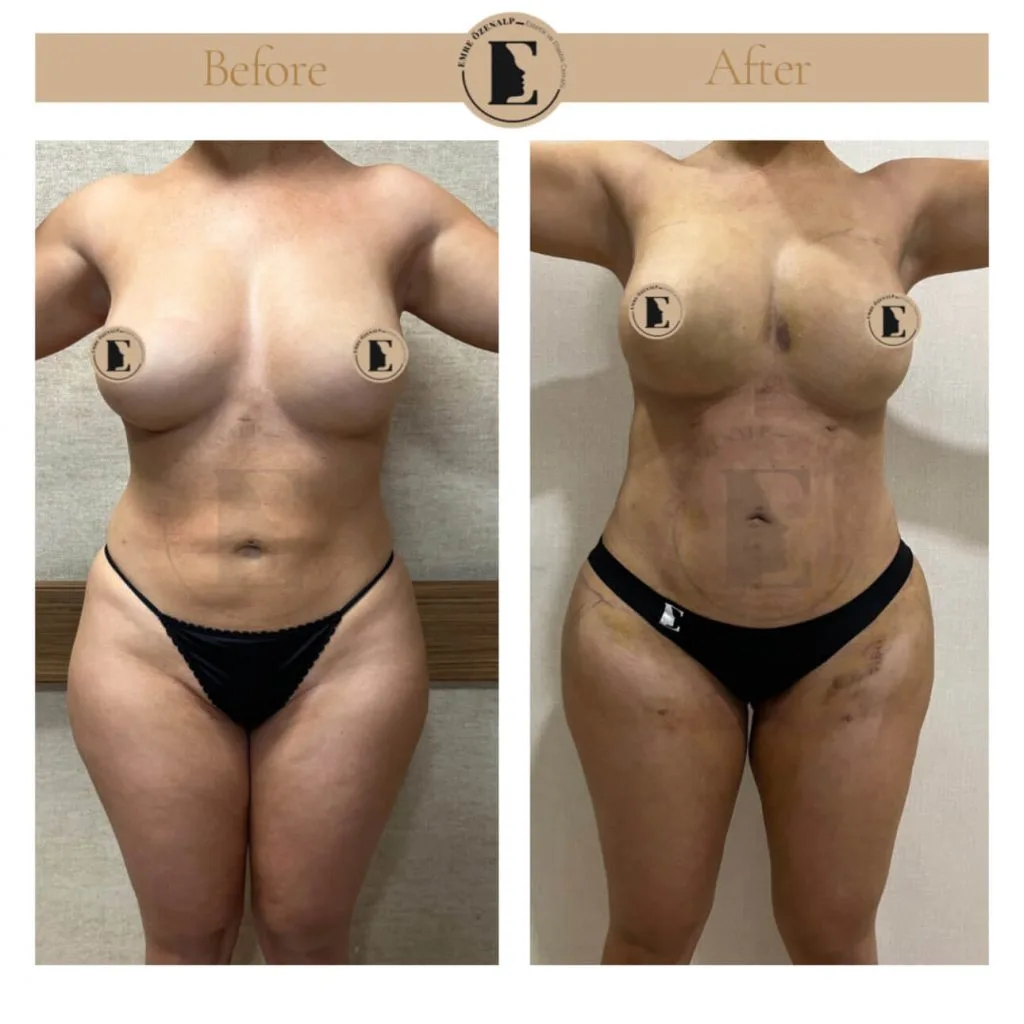Liposuction before after in Turkey results with experienced doctor Emre Özenalp. The patient has been remove excess fat from abdomen area.