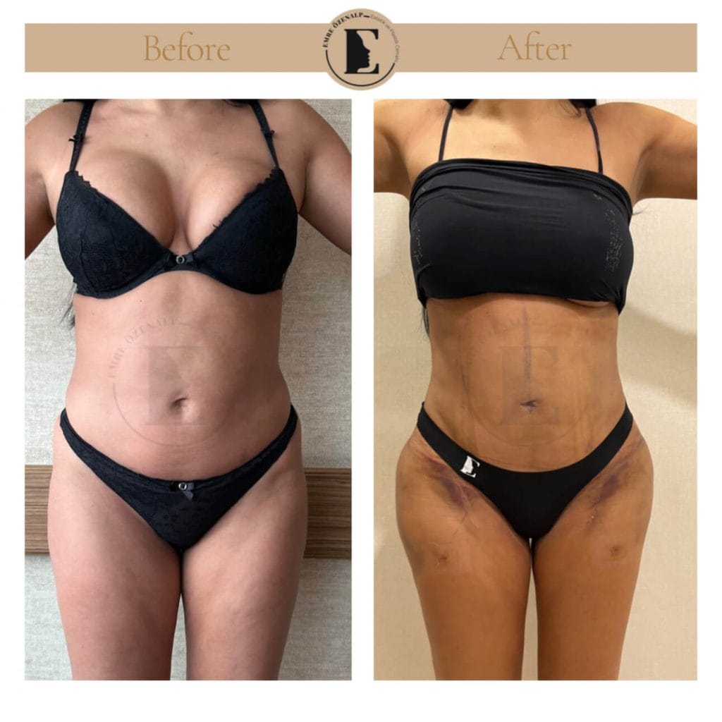 Liposuction before after in Turkey results with experienced doctor Emre Özenalp. The patient has been remove excess fat from abdomen area.