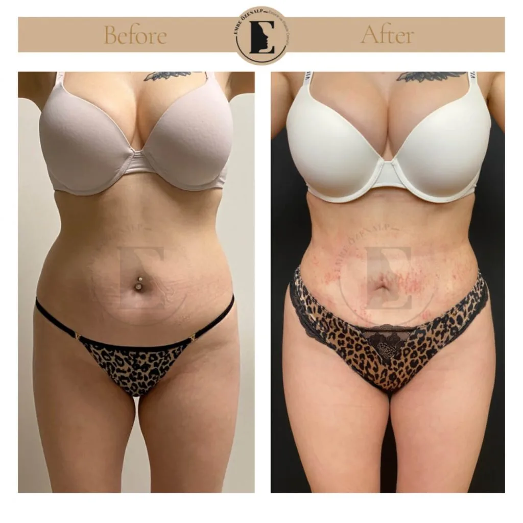 Liposuction before after in Turkey results with experienced doctor Emre Özenalp. The patient has been remove excess fat from abdomen area.