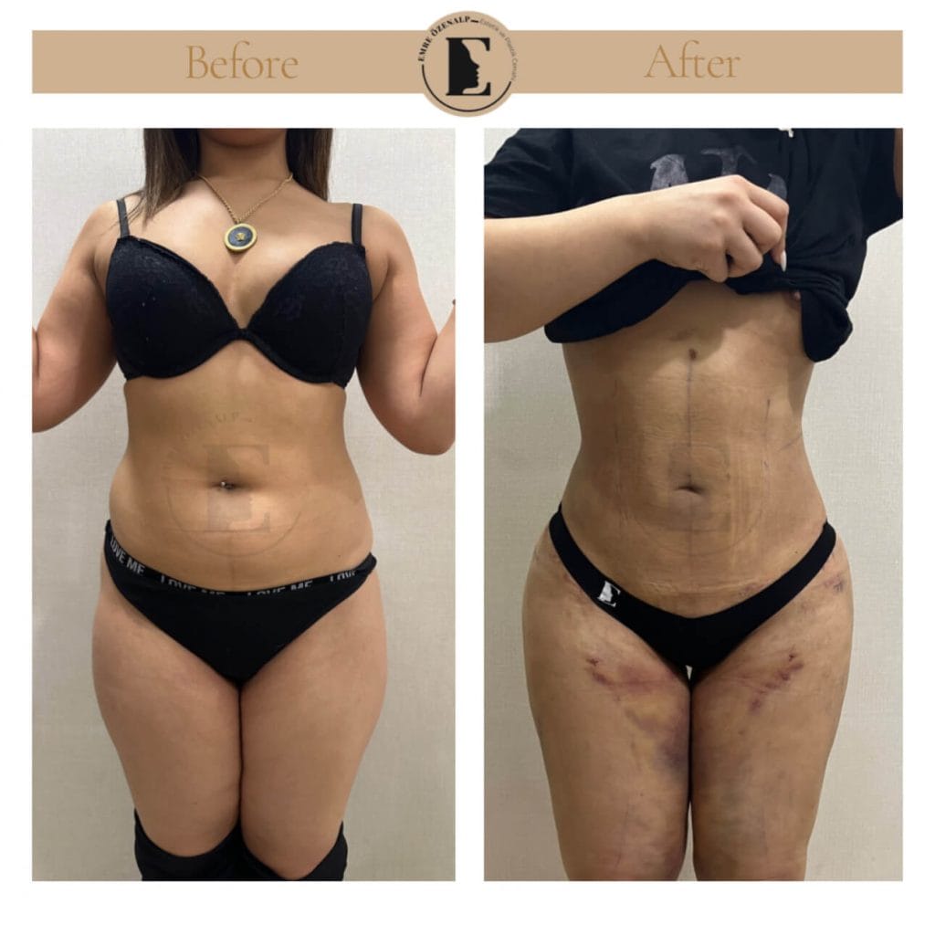 Liposuction before after in Turkey results with experienced doctor Emre Özenalp. The patient has been remove excess fat from abdomen area.
