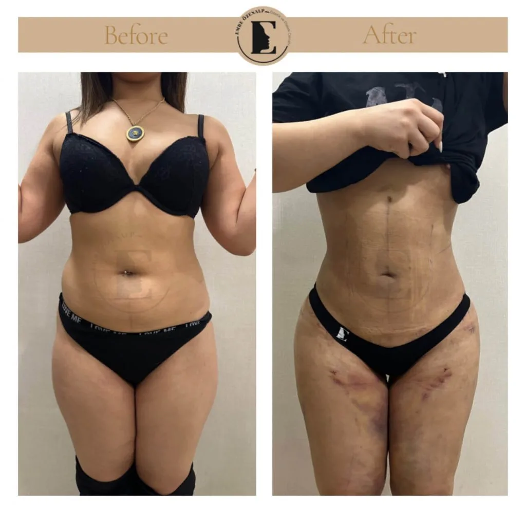 Liposuction before after in Turkey results with experienced doctor Emre Özenalp. The patient has been remove excess fat from abdomen area.
