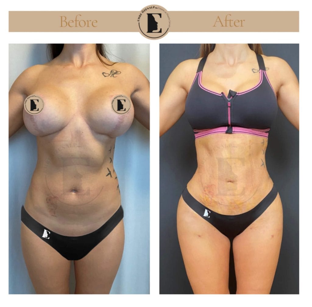 Liposuction before after in Turkey results with experienced doctor Emre Özenalp. The patient has been remove excess fat from abdomen area.