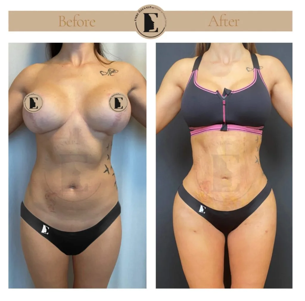 Liposuction before after in Turkey results with experienced doctor Emre Özenalp. The patient has been remove excess fat from abdomen area.