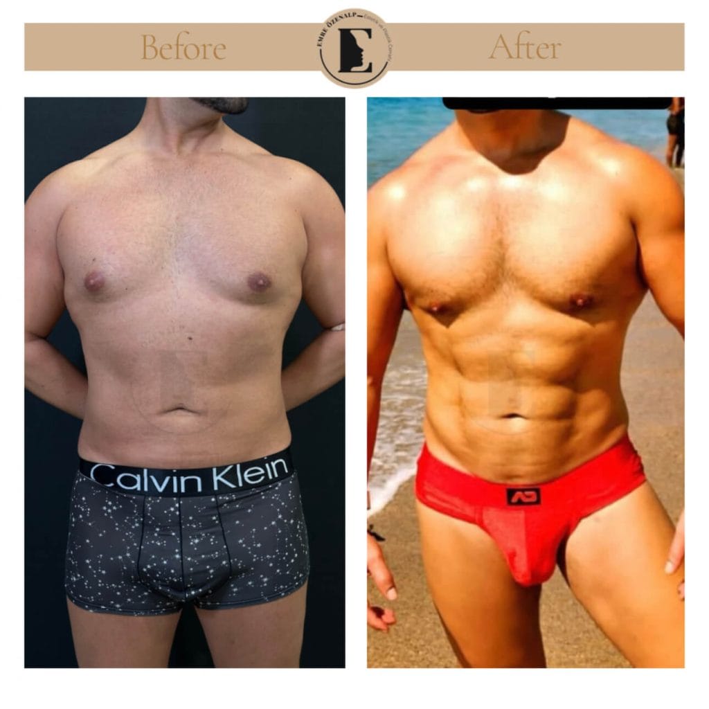 Hi-Def Liposuction before after in Turkey results with experienced doctor Emre Özenalp. The patient has been remove excess fat from abdomen and applied hi-def technology for creating six-pack appearance.
