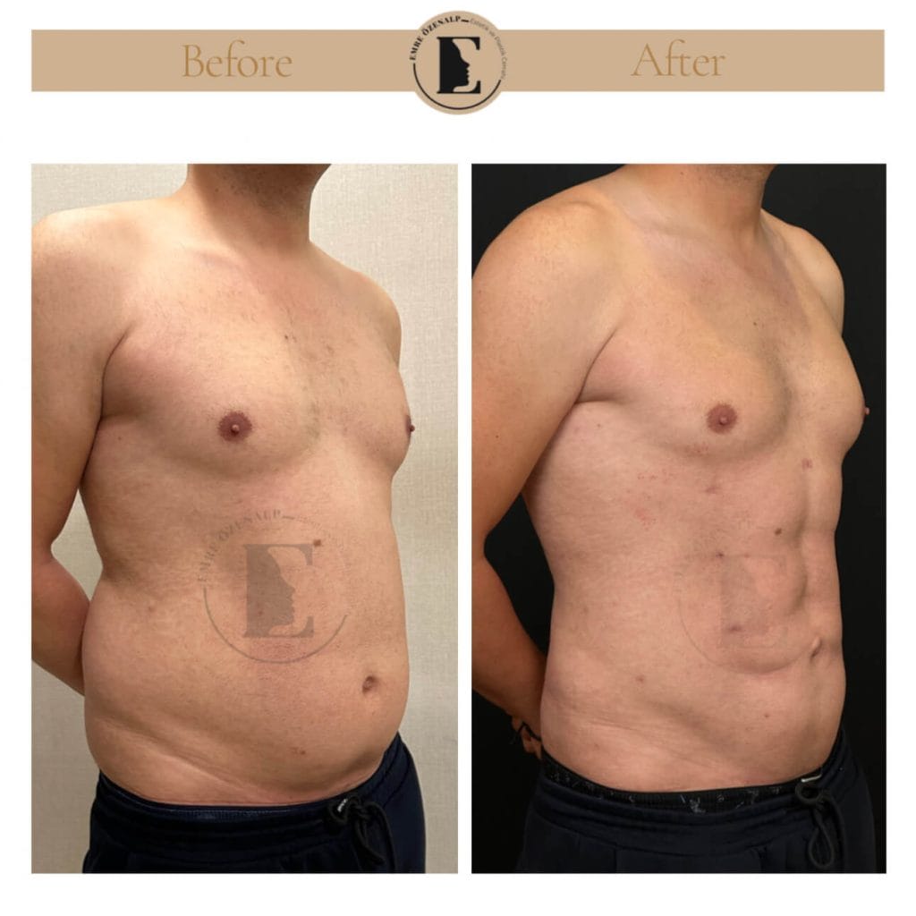 Hi-Def Liposuction before after in Turkey results with experienced doctor Emre Özenalp. The patient has been remove excess fat from abdomen and applied hi-def technology for creating six-pack appearance.
