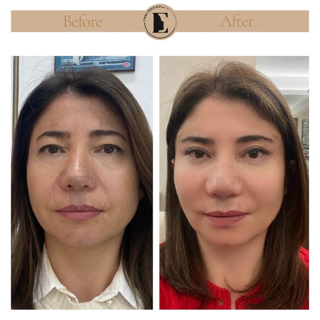 Brow lift before after in Turkey results with experienced doctor Emre Özenalp. The patient has been done eyebrow lift surgery.