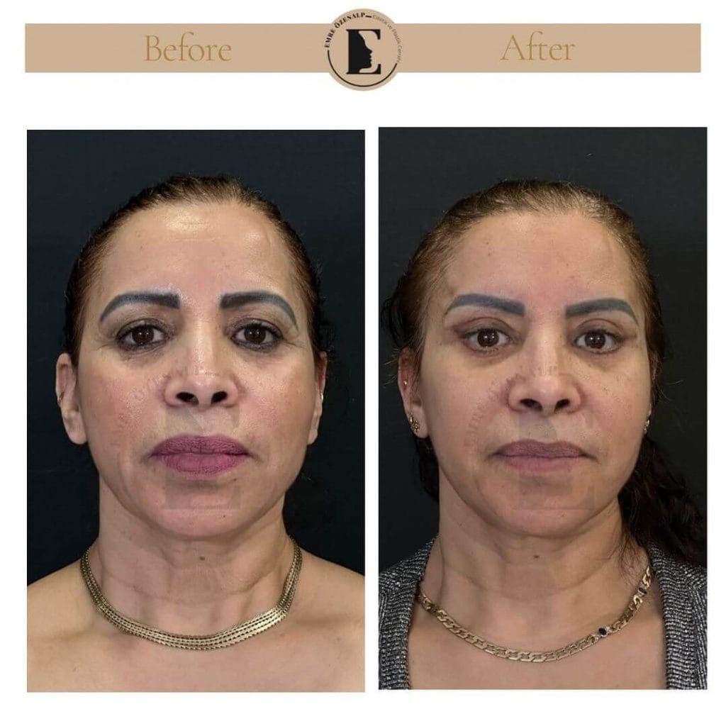 Brow lift before after in Turkey results with experienced doctor Emre Özenalp. The patient has been done eyebrow lift surgery.
