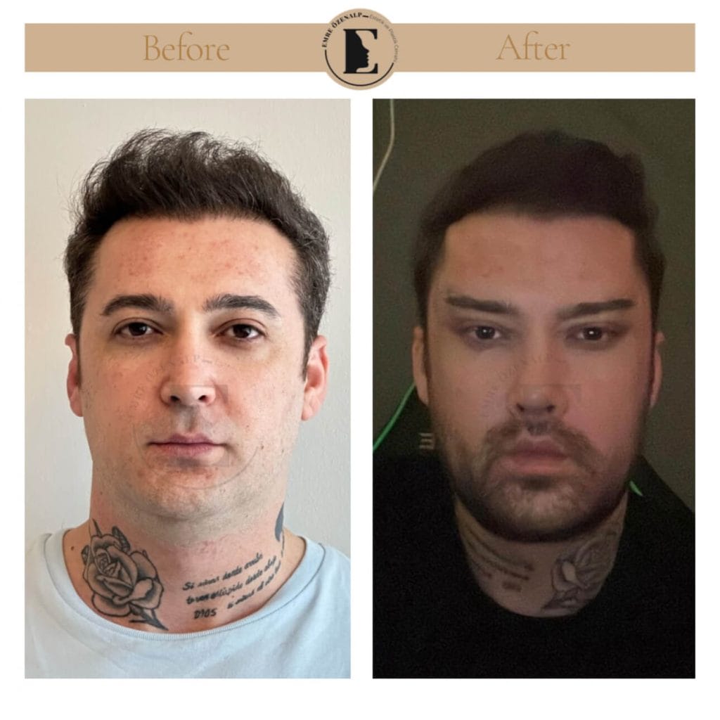 Brow lift before after in Turkey results with experienced doctor Emre Özenalp. The patient has been done eyebrow lift surgery.
