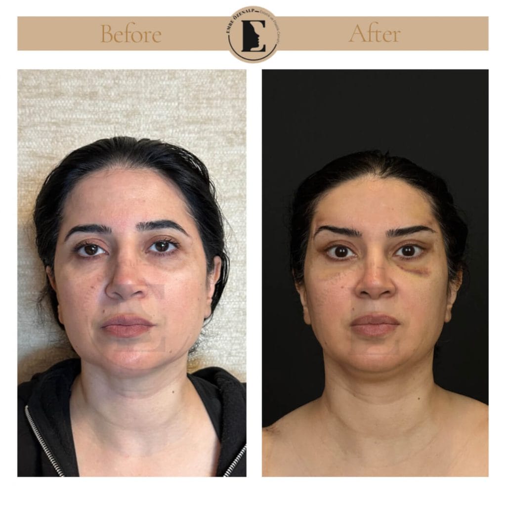 Brow lift before after in Turkey results with experienced doctor Emre Özenalp. The patient has been done eyebrow lift surgery.