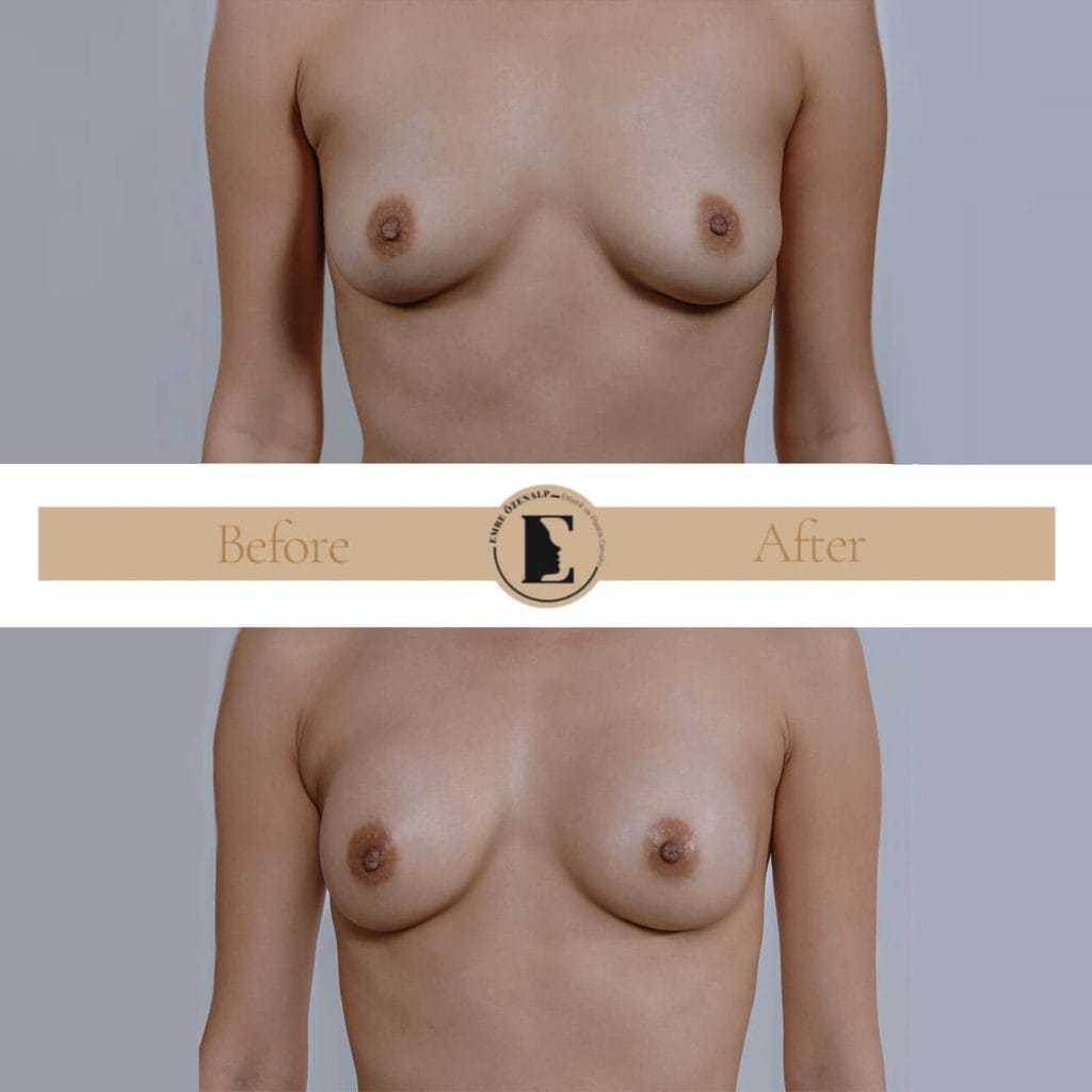MIA Femtech breast augmentation before after result 1 Cup up