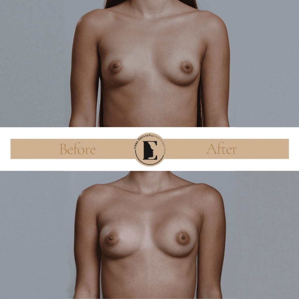 MIA Femtech breast enlargement before after result 1 Cup up
