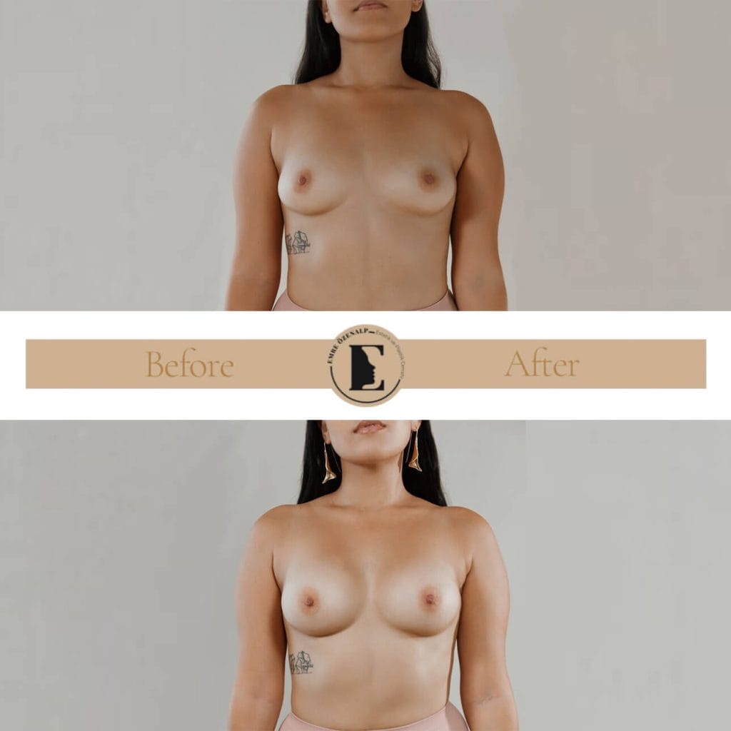 MIA Femtech breast augmentation before after result 1 Cup up