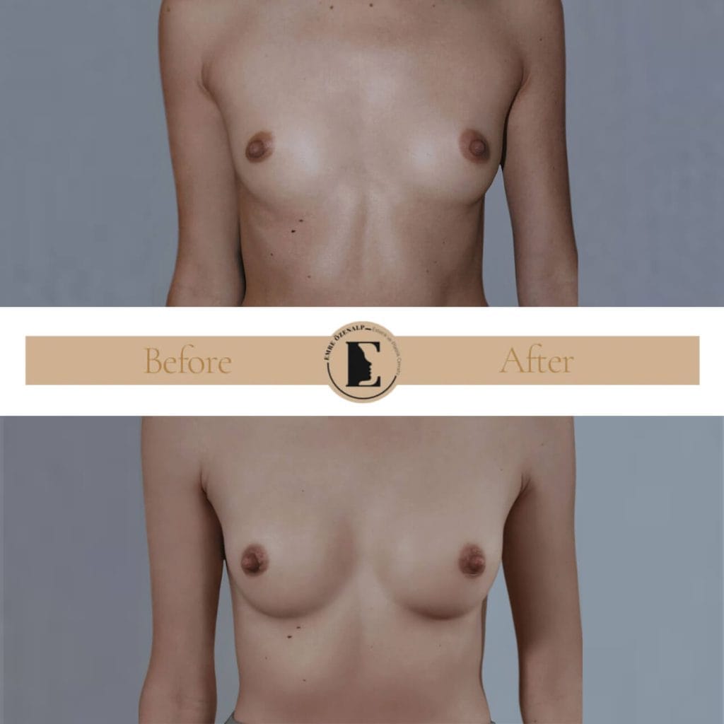 MIA Femtech breast harmonization before after result 1 Cup up