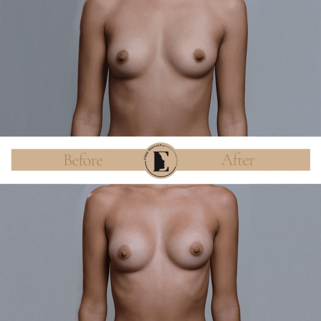 MIA Femtech breast augmentation before after result 2 Cups up