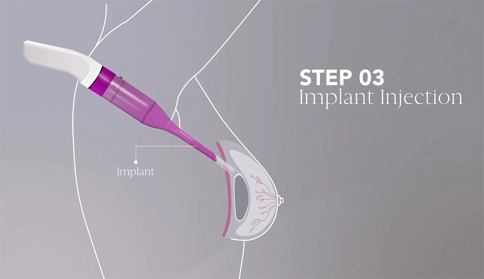 MIA Femtech Breast augmentation - Step 3: Implant injection