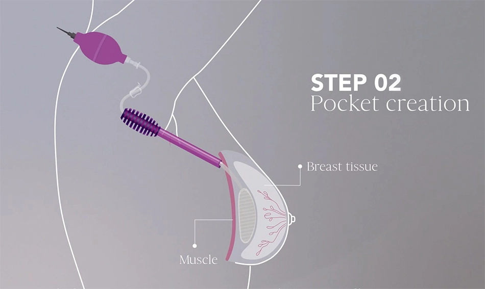 MIA Femtech Breast augmentation - Step 2: Pocket creation