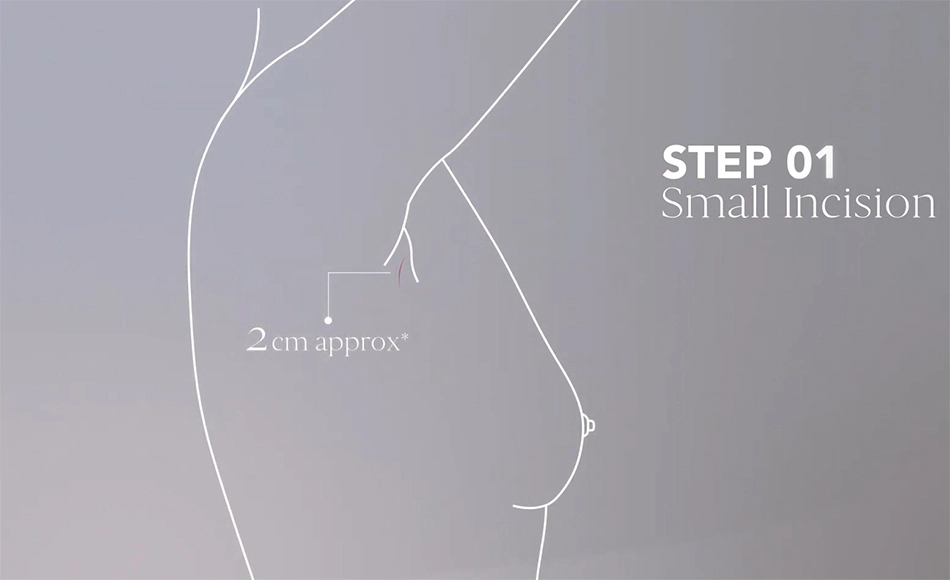 MIA Femtech Breast augmentation - Step 1: Small Inicison
