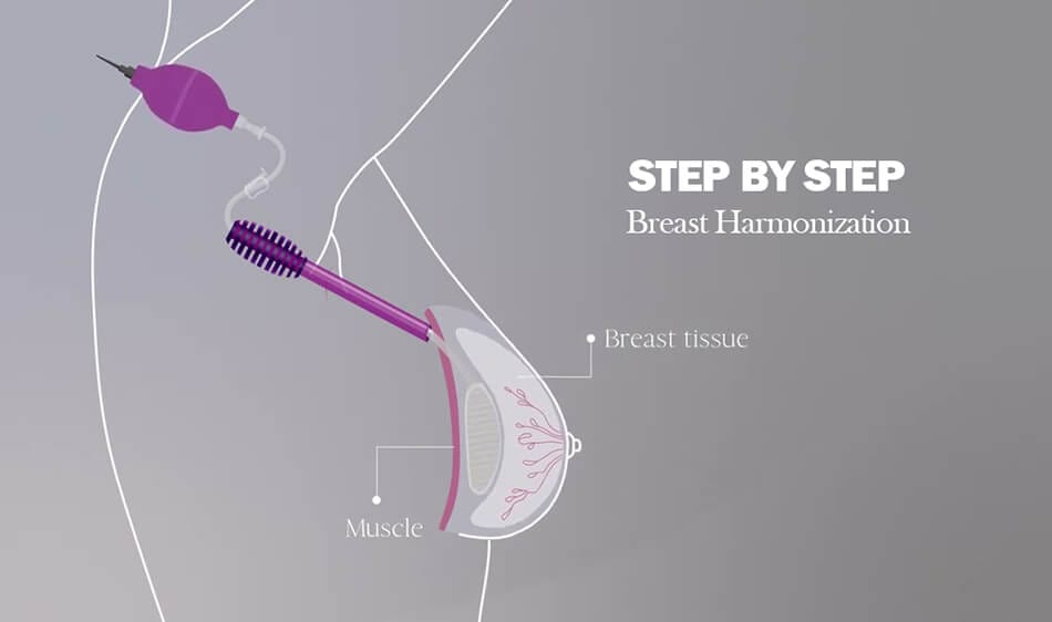 Step by step MIA Femtech breast harmonization video explain