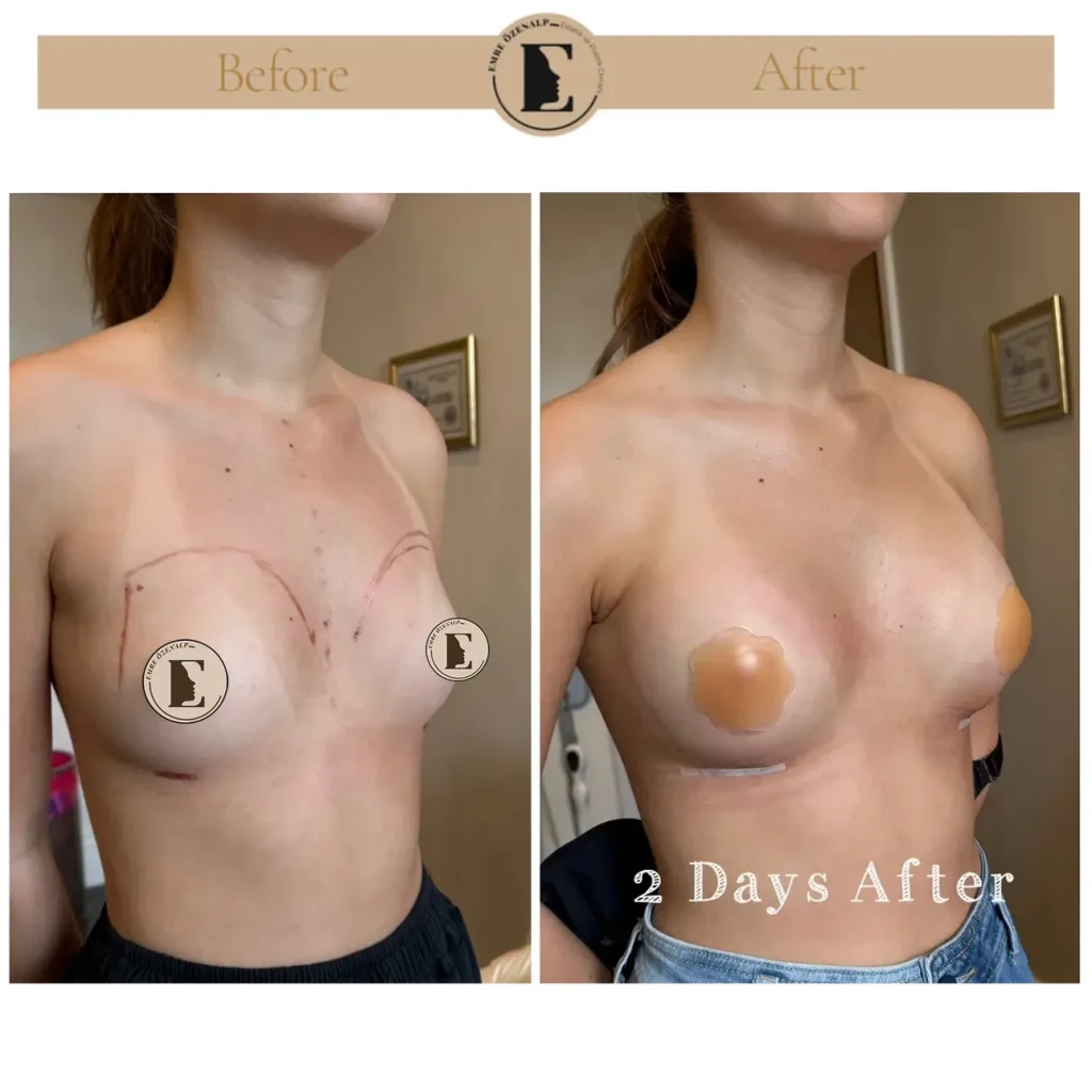 Motiva Preserve breast augmentation with Ergonomix2 275cc implant