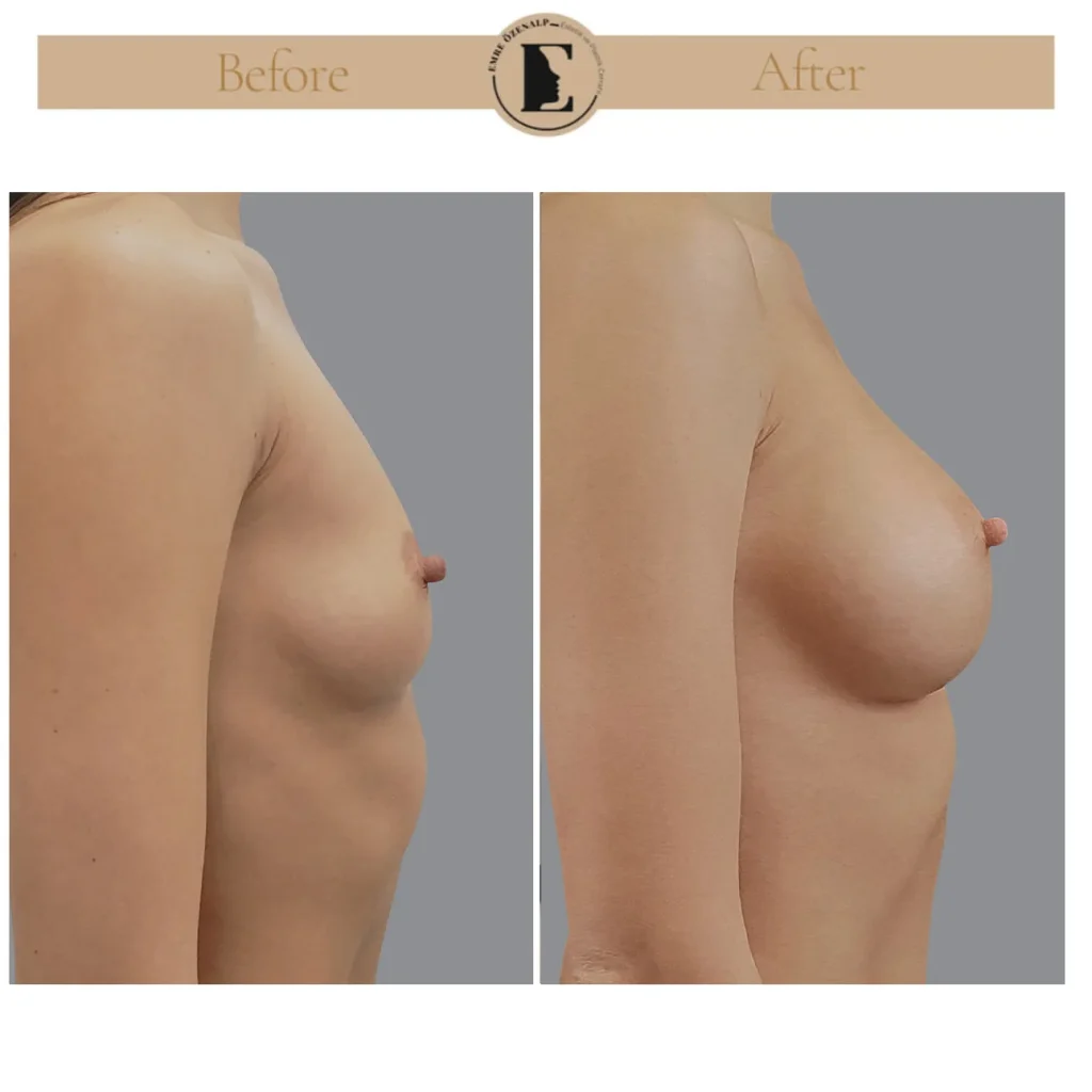 Motiva Preserve breast augmentation with Ergonomix2 315cc implant