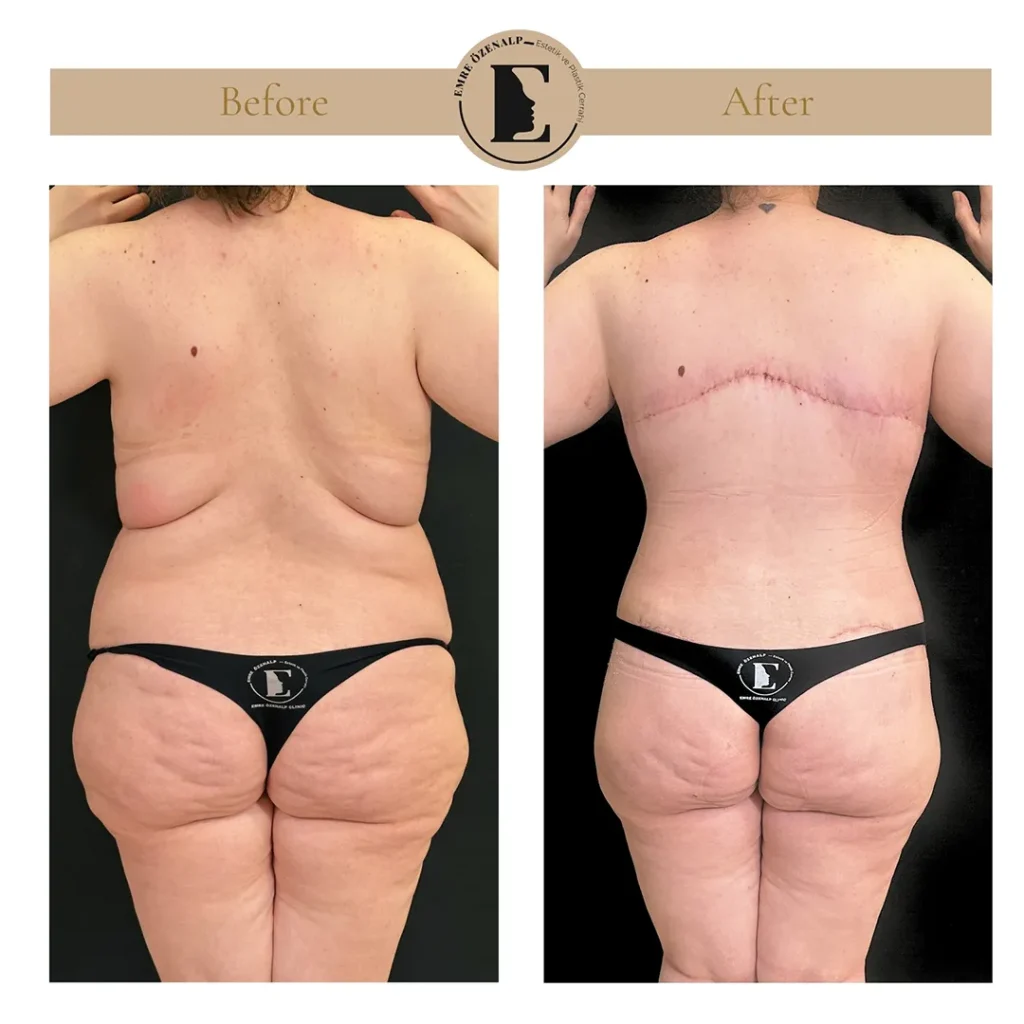 Bra line back lift scar healing progression from 1 month to 12 months post-surgery