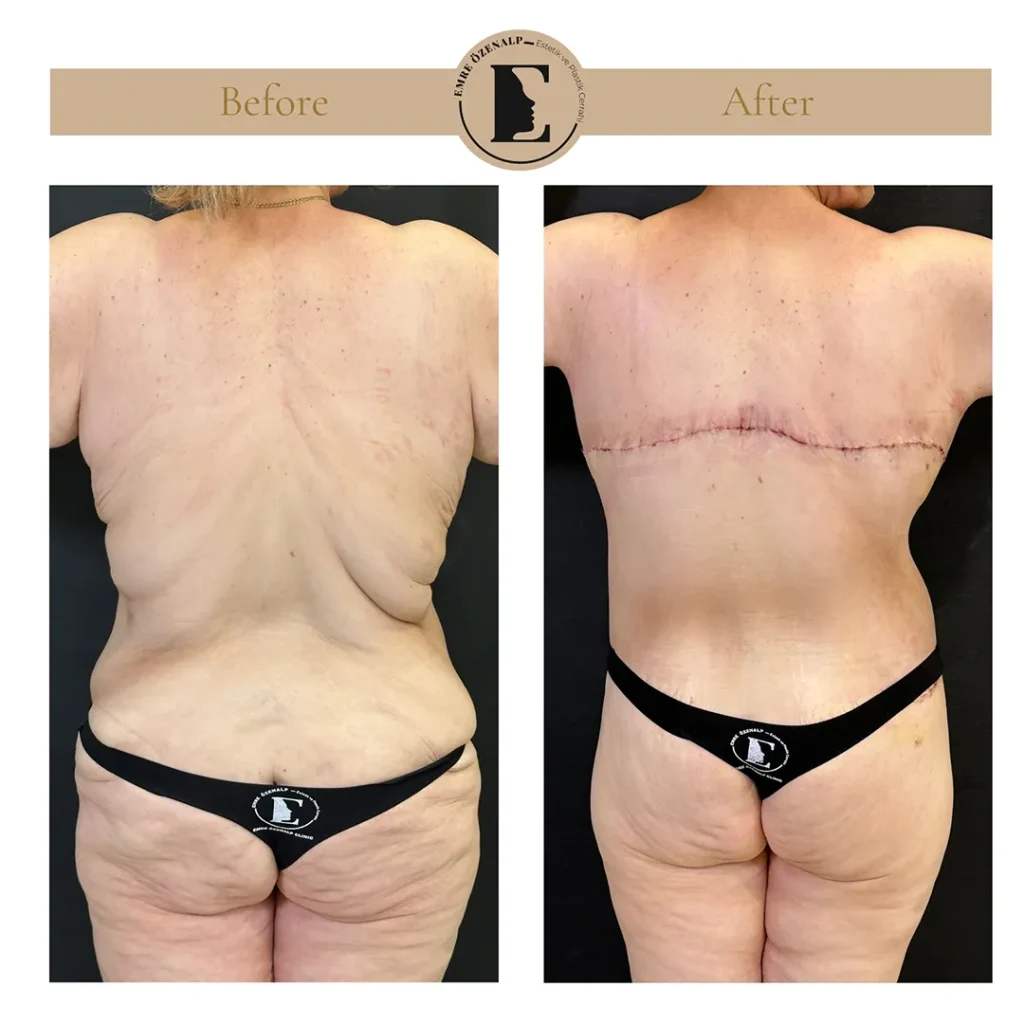 Bra line back lift final result at one year post-op with fully matured scar and settled contour