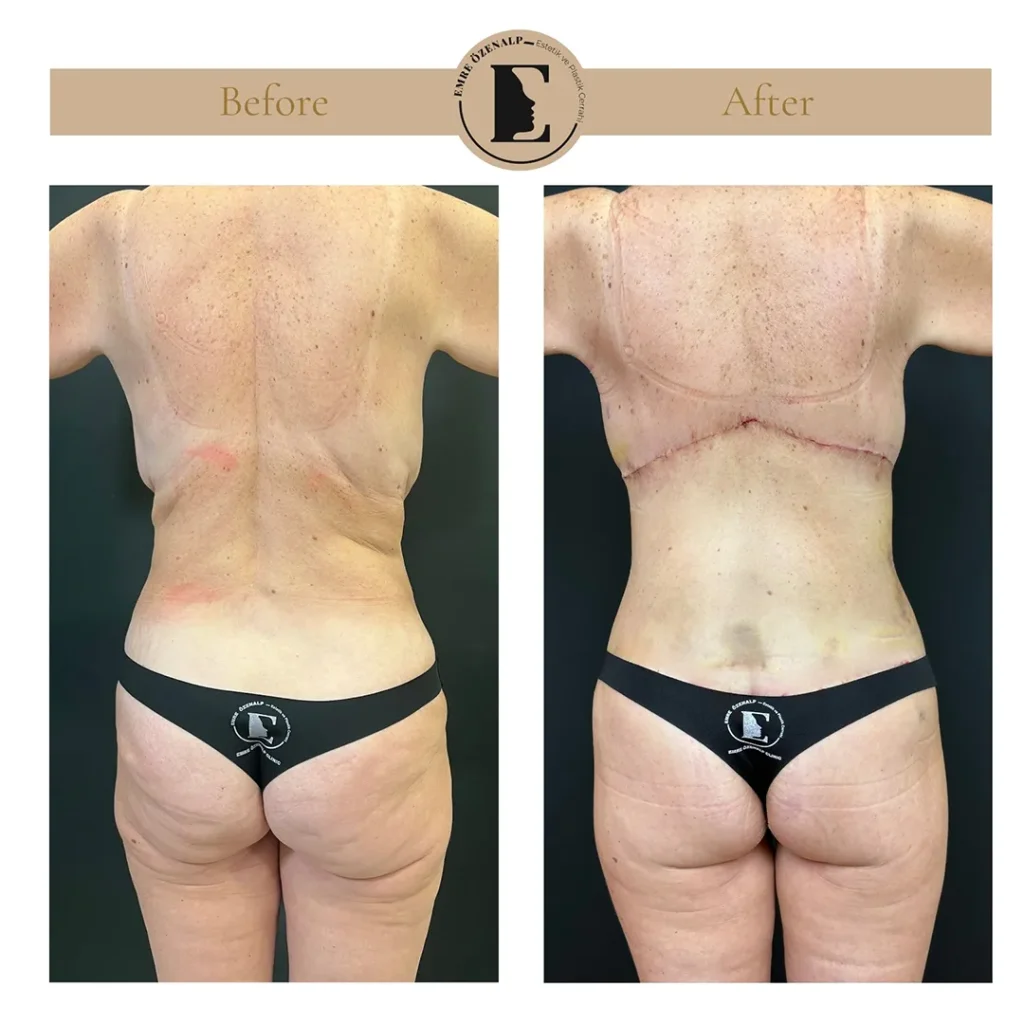 Back lift incision close-up showing thin scar line hidden along the bra strap area