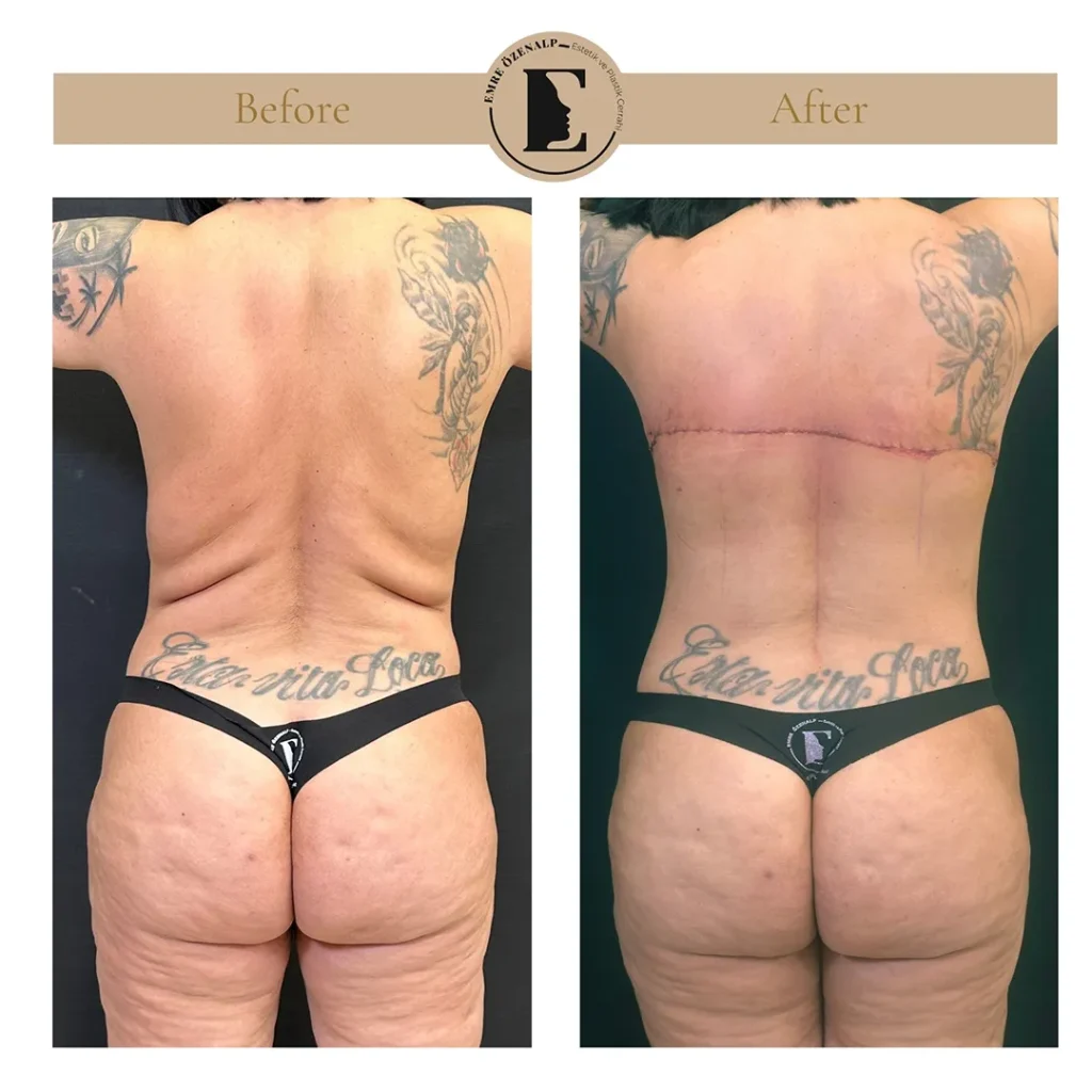 Bra line back lift before and after with arms raised showing smooth upper back contour