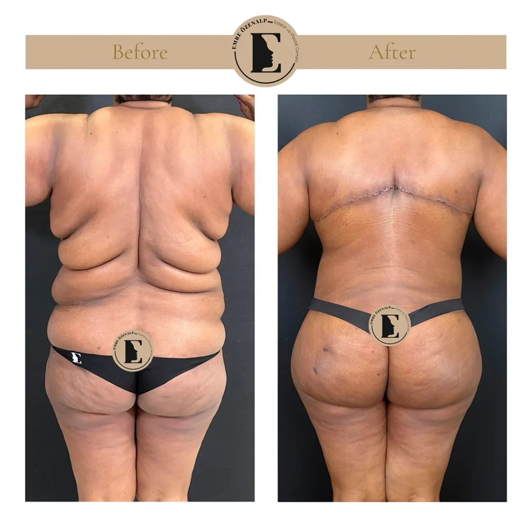 Back lift after major weight loss before and after showing dramatic skin removal result