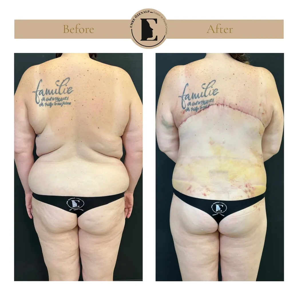 Back lift and tummy tuck combined before and after showing 360-degree body contouring result
