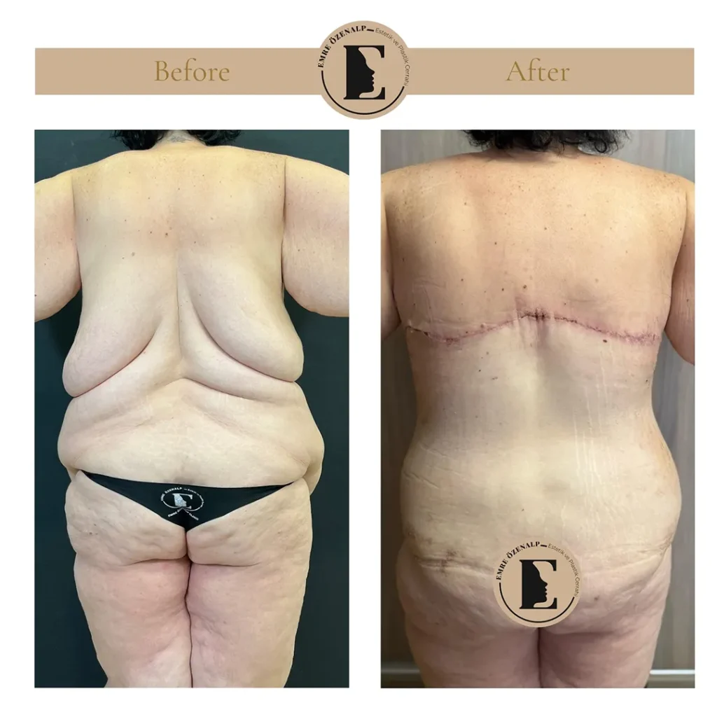 Bra line back lift combined with liposuction before and after showing refined back contour