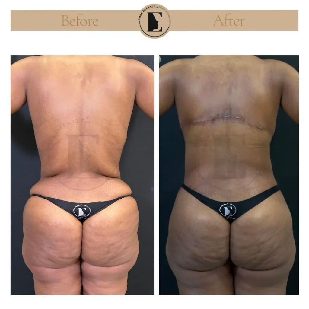 Upper back lift before and after in standing position showing elimination of back rolls