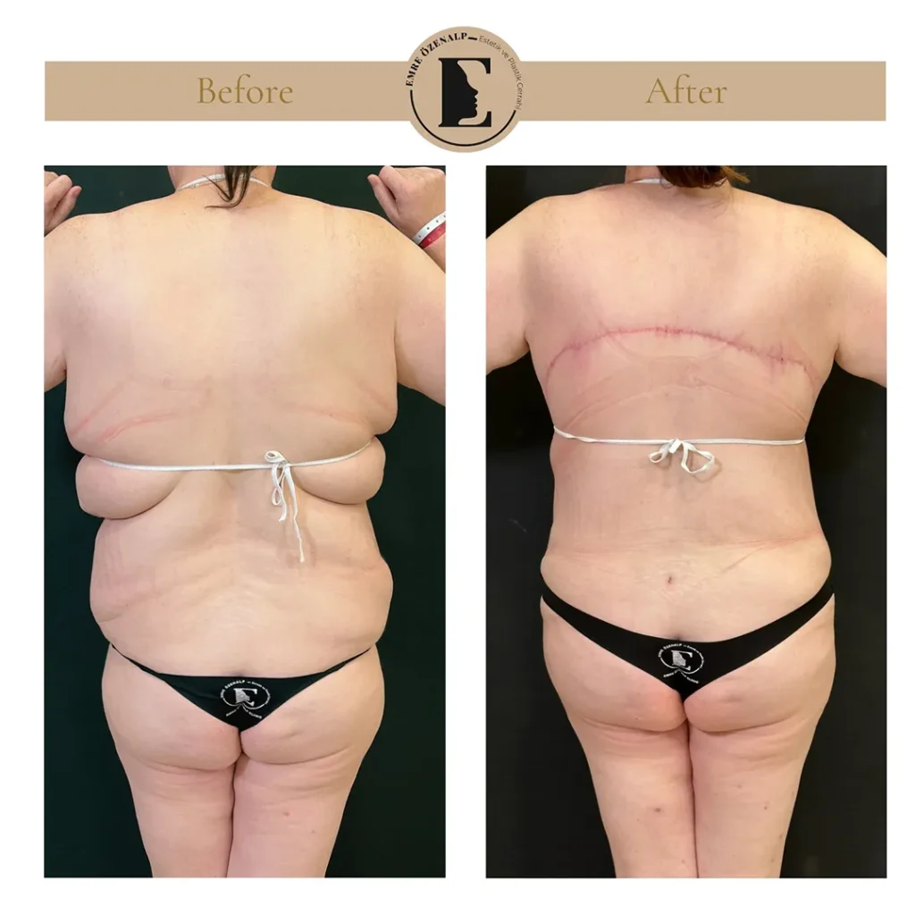 Bra line back lift result at 6 months post-op with mature scar hidden under bra line