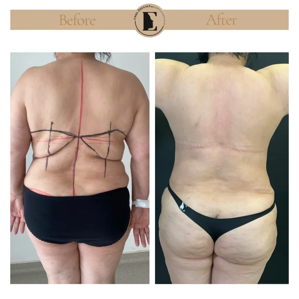 Back lift surgery before and after side profile showing improved upper back contour