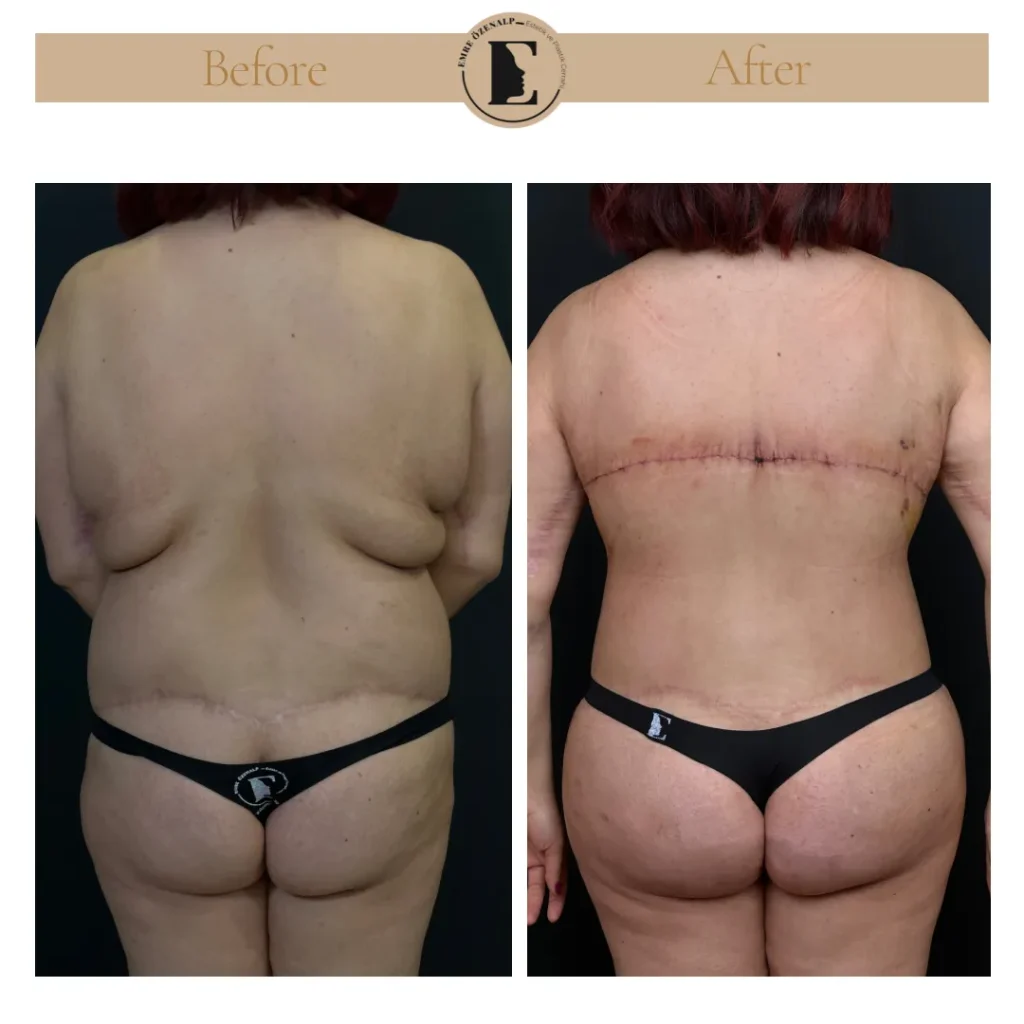 Bra line back lift before and after rear view showing removal of upper back skin folds
