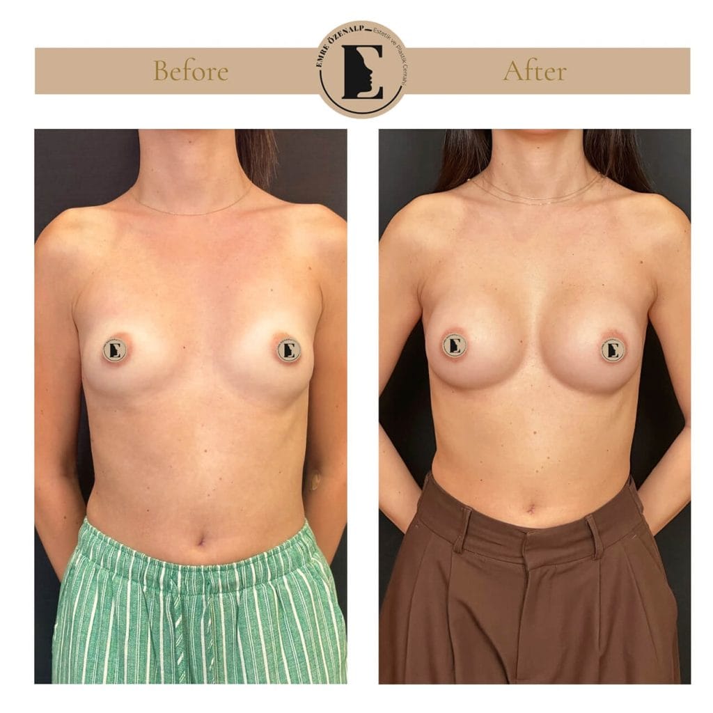 MIA Femtech before after result 2 Cup up