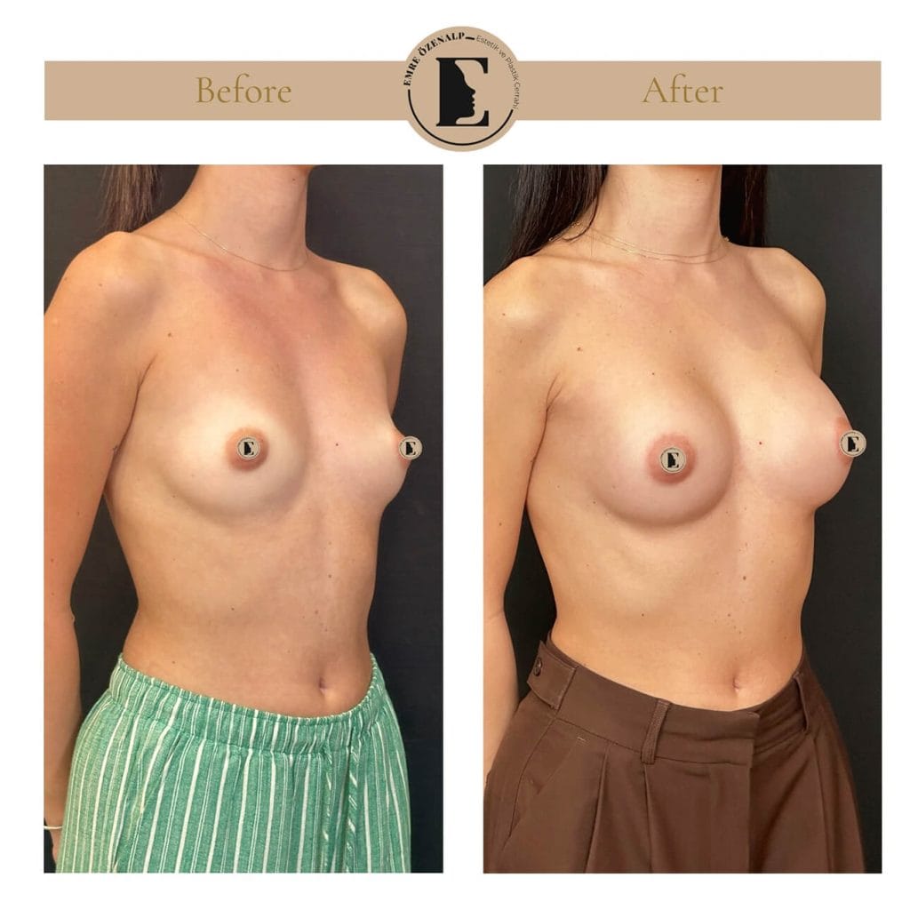 MIA Femtech before after result 2 Cup up